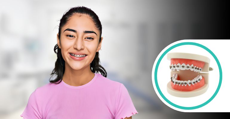 braces treatment