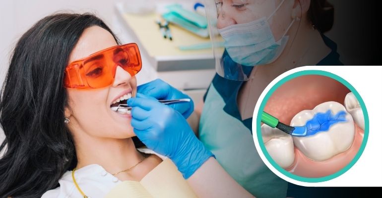 dental-sealants
