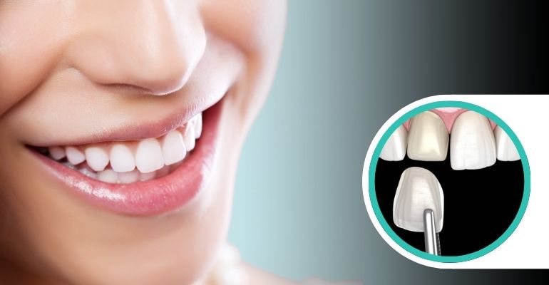 dental-veneers