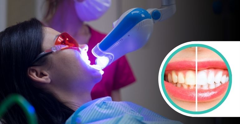 teeth-whitening