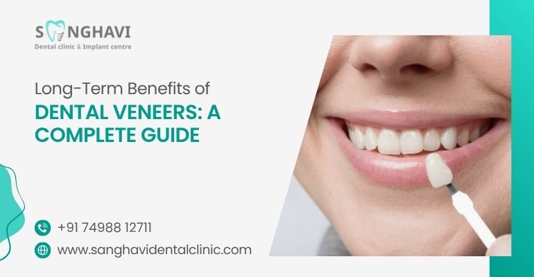 Long-Term Benefits of Dental Veneers: A Complete Guide